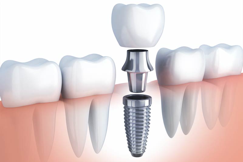 Implants Dentist in Monroe