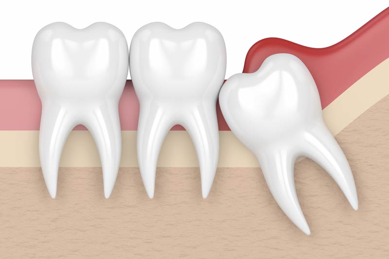 Wisdom Tooth Removal in Monroe